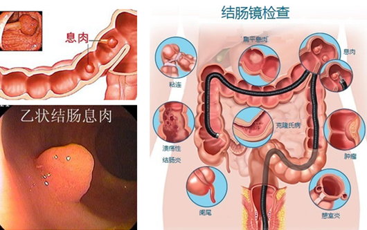 萎縮性胃炎真的“很?chē)樔恕?？看完這“七個(gè)事實(shí)”你就明白了
