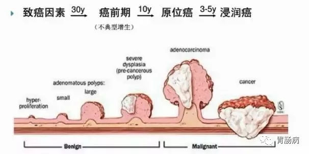 體檢查出腸息肉一定要切除！ 95%腸癌由它演變而來(lái)