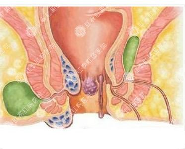 南寧哪個(gè)醫院可以做肛周膿腫？