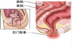 南寧治療脫肛哪家醫院好？南寧脫肛治療多少錢(qián)？